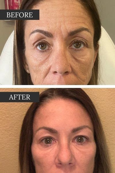 Botox In Tulsa Align Injectable Aesthetics