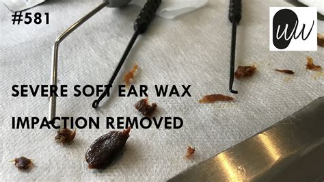 581 Severe Soft Ear Wax Impaction Removed Youtube