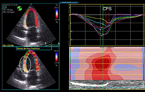 Ecocardiografia De Estresse Parte 3 Blog Ecope