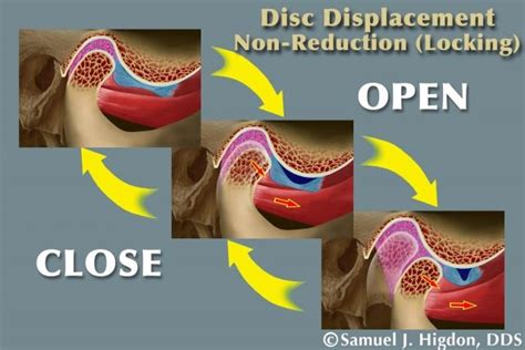 Steps To Simplifying Tmd Diagnosis Dentistry Human Anatomy And