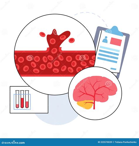 Brain Stroke Hemorrhagic Stock Vector Illustration Of Apoplexy 225570039