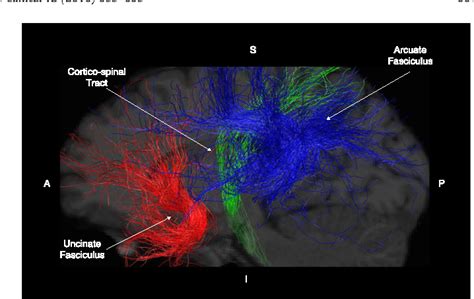 Figure From Structural Brain Abnormalities In A Single Gene Disorder