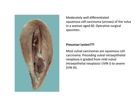 Ppt Pathology Of The Female Genital Tract Powerpoint Presentation