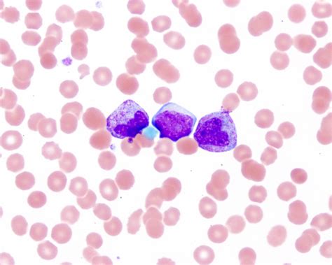 Pathology Outlines Reactive Neutrophilia