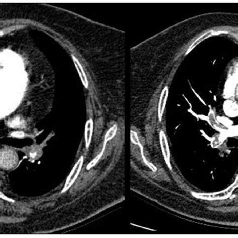 Axial Views Of Thoracic Contrast Enhanced Ct The Pte At The Right