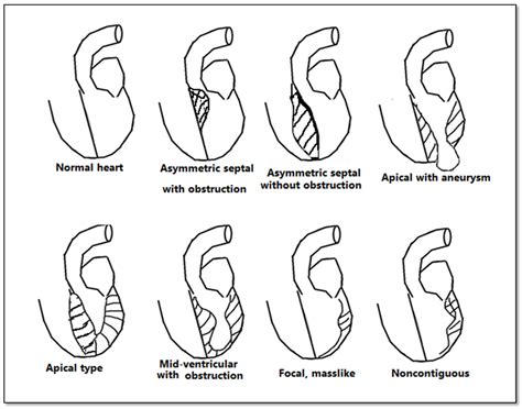 Anatomical MRI Correlations In Hypertrophic Cardiomyopathy Adults And