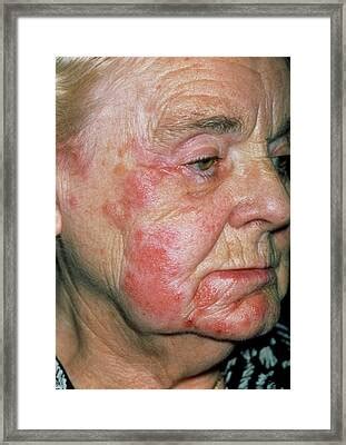 Herpes Zoster Rash On An Elderly Woman S Face Photograph By Dr P