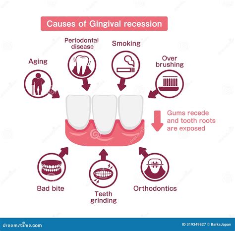 Causes of Gingival Recession. Vector Illustration Stock Vector