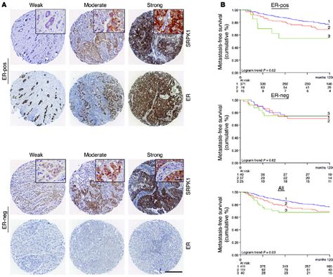 SRPK1 Protein Levels Correlate With Poor Prognosis In BC Patients A