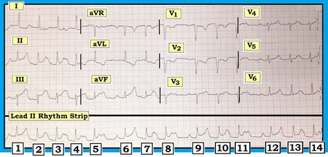 ECG Interpretation: ECG Interpretation Review #55 (Mobitz I - Mobitz II ...