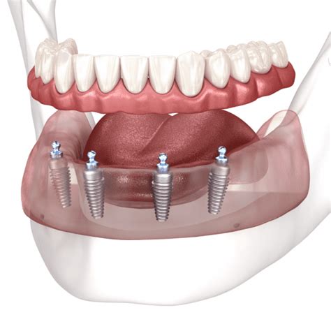 Permanent Dentures Types Pros Cons Costs Teeth Wisdom