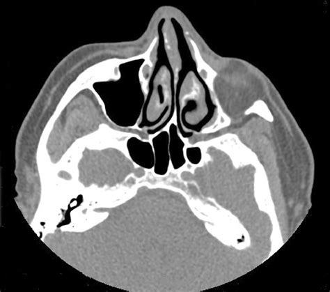 Etiology Early Diagnosis And Proper Treatment Of Silent Sinus Syndrome Based On Review Of The