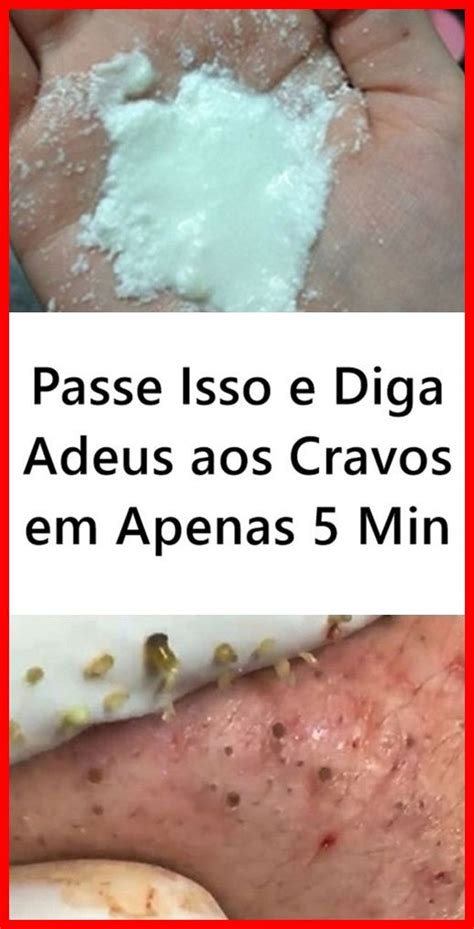 Receita Caseira Para Eliminar Os Cravos Em Minutos Passo A Passo