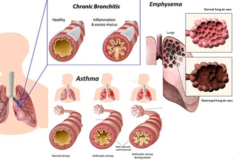 Asthma Treatment