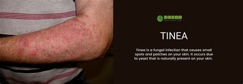 Tinea Corporis Treatment in Mumbai | Tinea Versicolor - Gloss Clinic