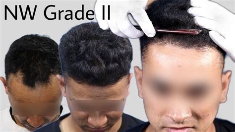 Best Hair Transplant Result 2021 Norwood Grade 2 2165 Grafts Regrow Clinic Youtube