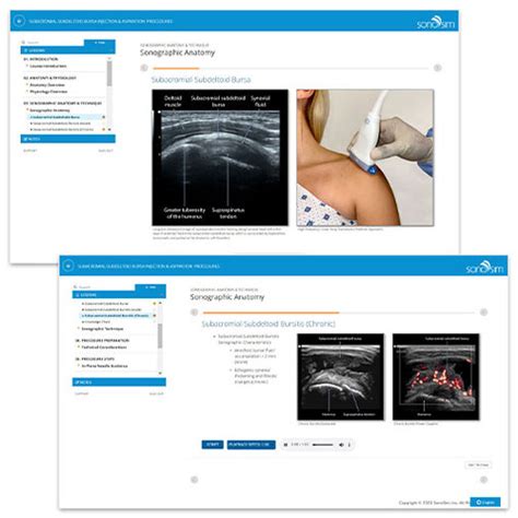 Subacromial Injection - Subacromial Shoulder Injection Ultrasound