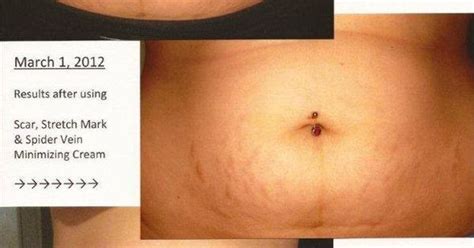 Bc Scar Stretch Mark And Spider Vein Cream Before And After Veins