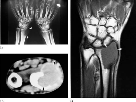 Giant Cell Tumor Mri