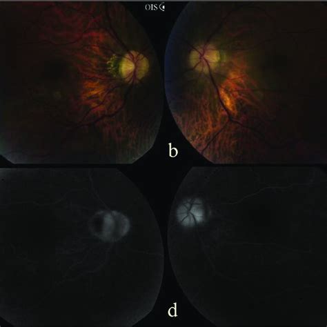 Fundus Photography A B And Fundus Fluorescein Angiography C D At