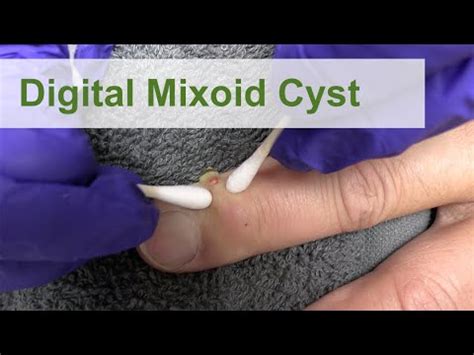 Digital Mixoid Cyst Dr Derm YouTube