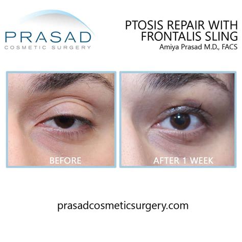 Healing After Ptosis Surgery | Dr. Prasad Blog