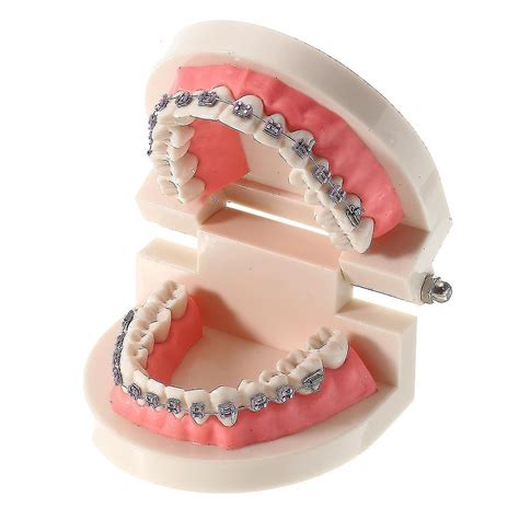 Dental Teeth Malocclusion Orthodontic Model With Full Metal Brackets