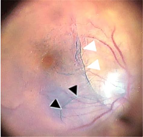 Intra Operative Aspect Of A Spontaneous Tear Of The Internal Limiting