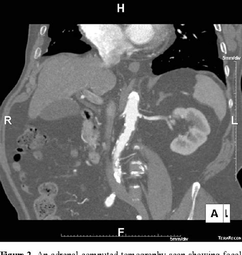 Figure 1 From Renal Artery Stenosis Presenting At Sudden Flash Pulmonary Edema In A Patient With