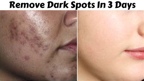 In 3 Days Remove Dark Spots Black Spots And Acne Scars Get Rid Of