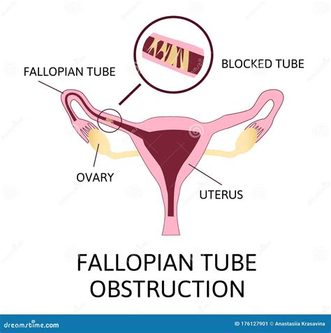 Fallopian Tube Blockage