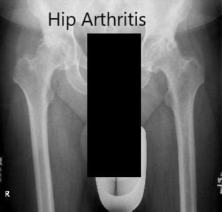 Case Study Bilateral Total Hip Replacement In Year Old