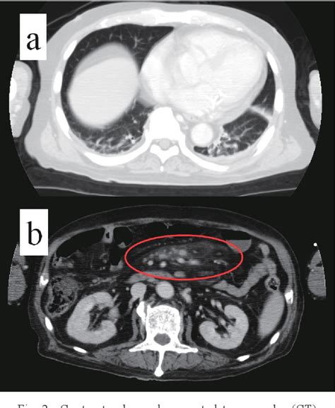 Figure From Hemophagocytic Lymphohistiocytosis Associated With