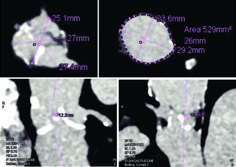 Ct Aortogram Measurements Aortic Annulus Up Left Sinus Of Valsalva