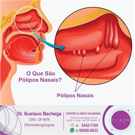 O Que É Um Pólipo Nasal