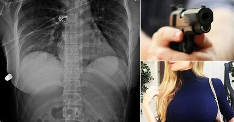 Womans Breast Implants Saved Her Life By Deflecting A Bullet From A