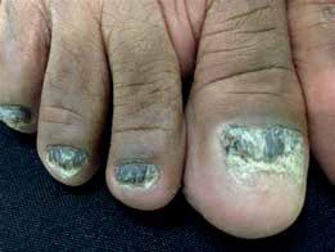 Lichen Planus Nails