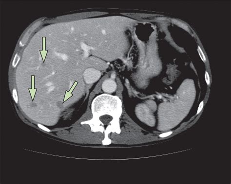 Second Line Systemic Therapy And Emerging Drugs For Metastatic