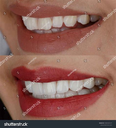 Porcelain Veneers Cost Sydney Factors That Affect Pricing