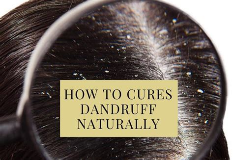 How To Cures Dandruff Naturally Biophytopharm