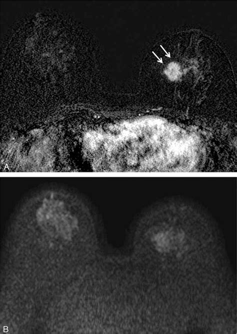 Invasive Ductal Carcinoma Of The Left Breast In A 60 Y Old Woman A