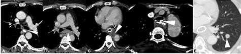 Esophageal carcinoma staging on axial contrast-enhanced computed ...