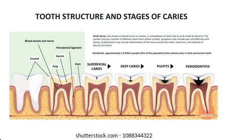 Tooth Structure Stages Caries Stock Illustration 1088344322 | Shutterstock