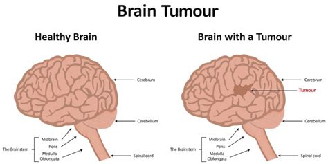 Understanding Brain Tumours Symptoms Treatments And Surgery