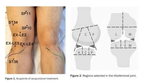 Acupuncture Vs Physical Therapy Jackupuncture