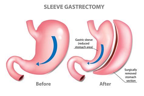 Gastric Sleeve Surgery St. Louis, MO | Sleeve Gastrectomy