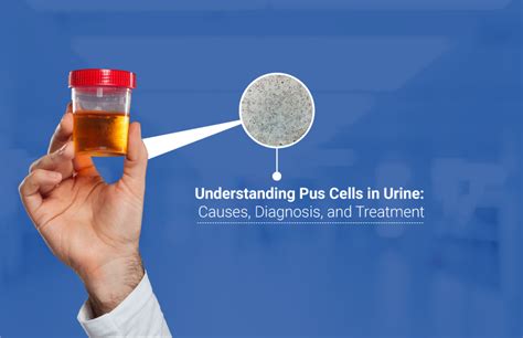 Understanding Pus Cells in Urine Causes, Diagnosis & Treatment