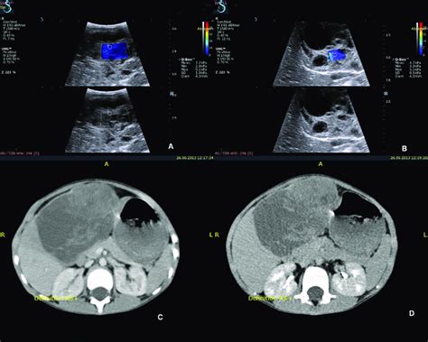 A B Swe Images Of A Year Old Boy Showed Solid Cystic Mixed Lesion