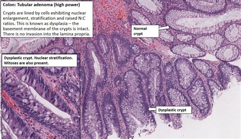 Colon Polyposis Coli Nus Pathweb Nus Pathweb