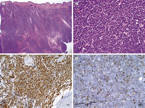 A A Punch Biopsy Specimen Of A Scalp Lesion In Patient 2 Revealed A